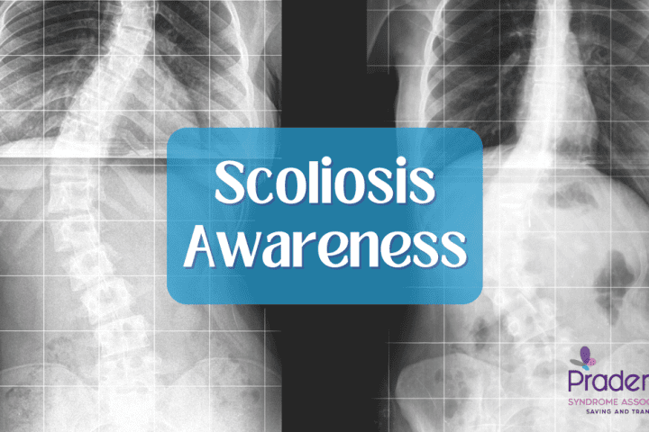 two x-ray images of adults with Prader-Willi syndrome and scoliosis